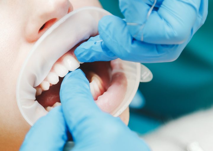 close-up-of-female-mouth-with-retractor-doctor-flossing-the-teeth.jpg