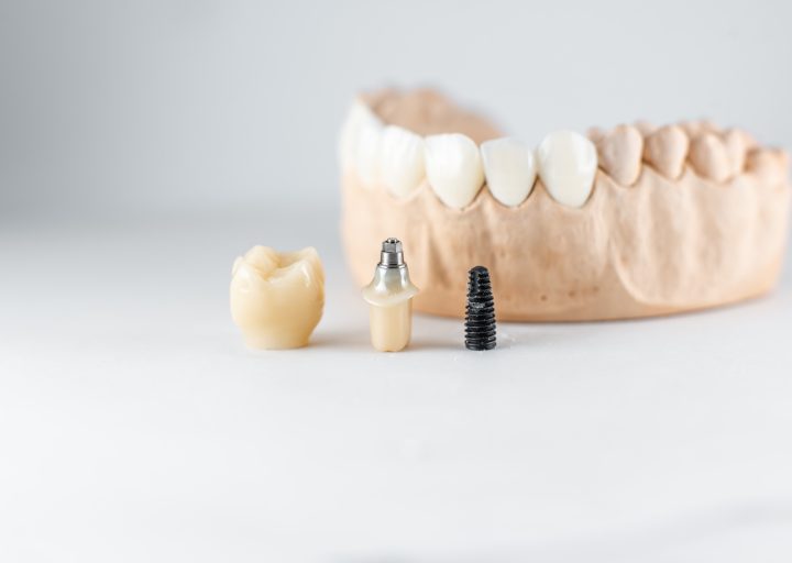model-of-artificial-jaw-and-dental-implant.jpg